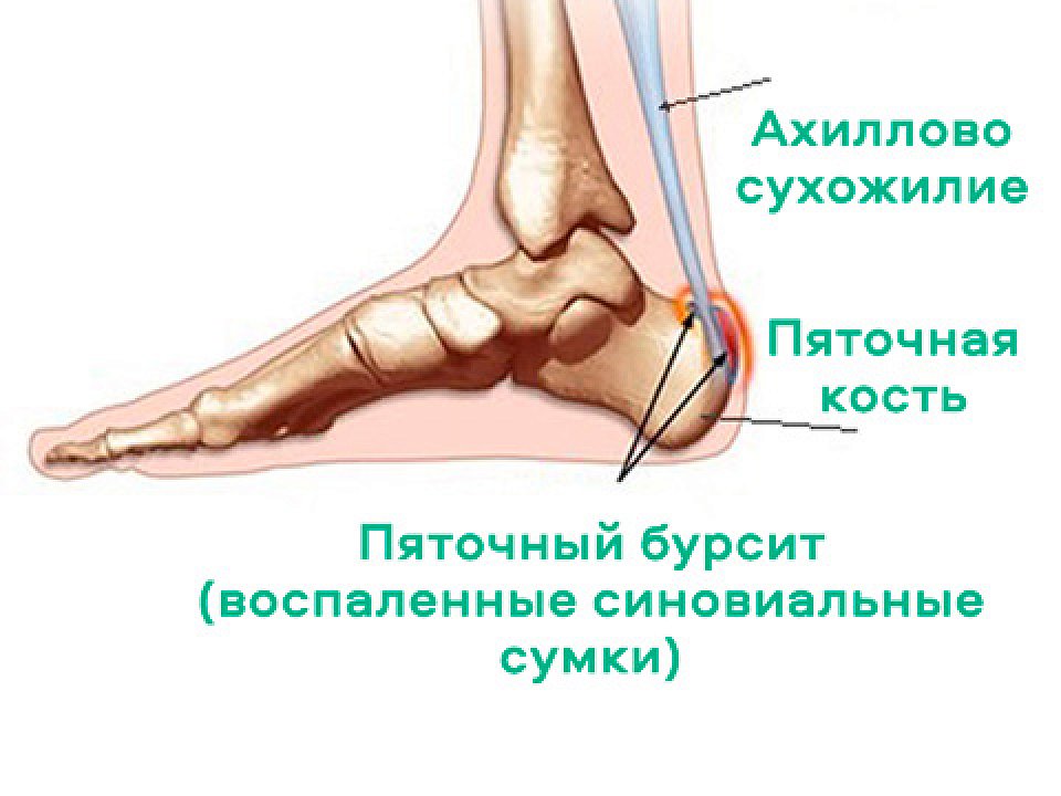 Ахиллобурсит. Бурсит сумки пяточного сухожилия.